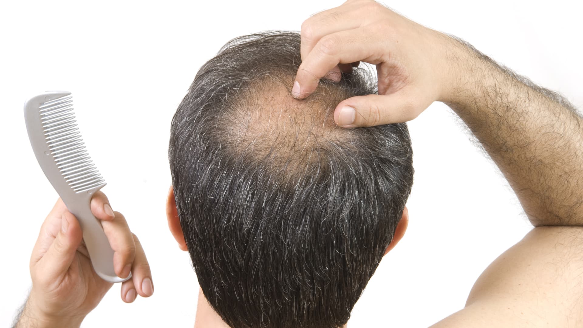 Baldness cure could be found in an osteoporosis drug, study finds