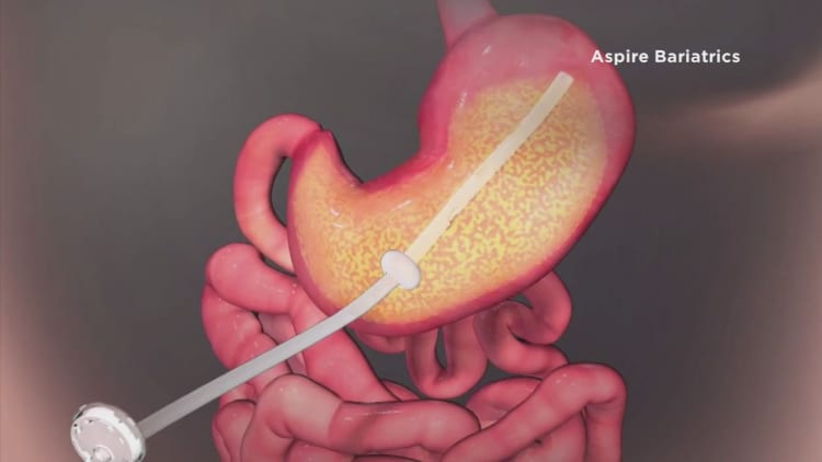 Weight-loss device that sucks food right out of your stomach