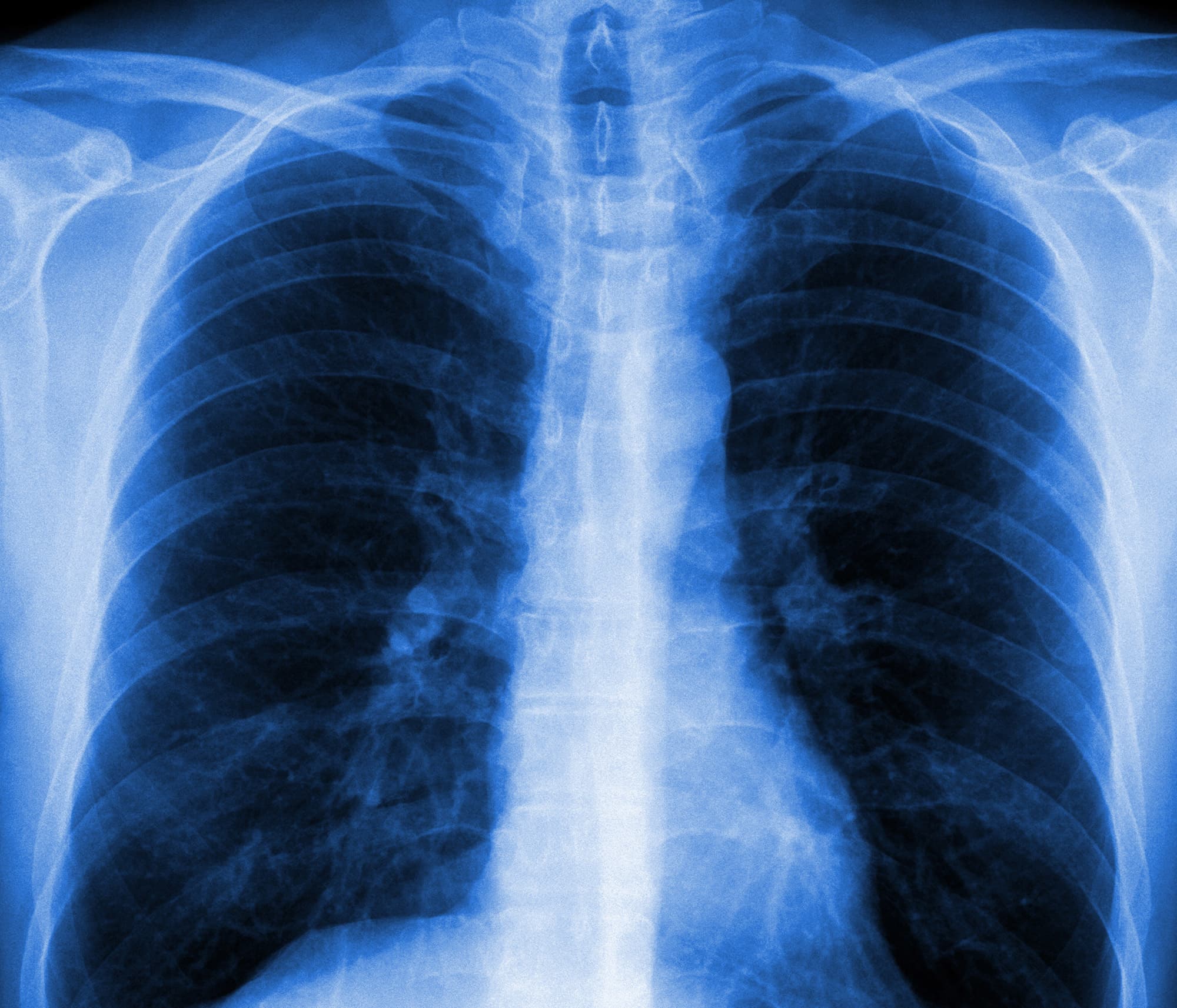 Biotech stock doubles treatment for a rare lung disease has successful