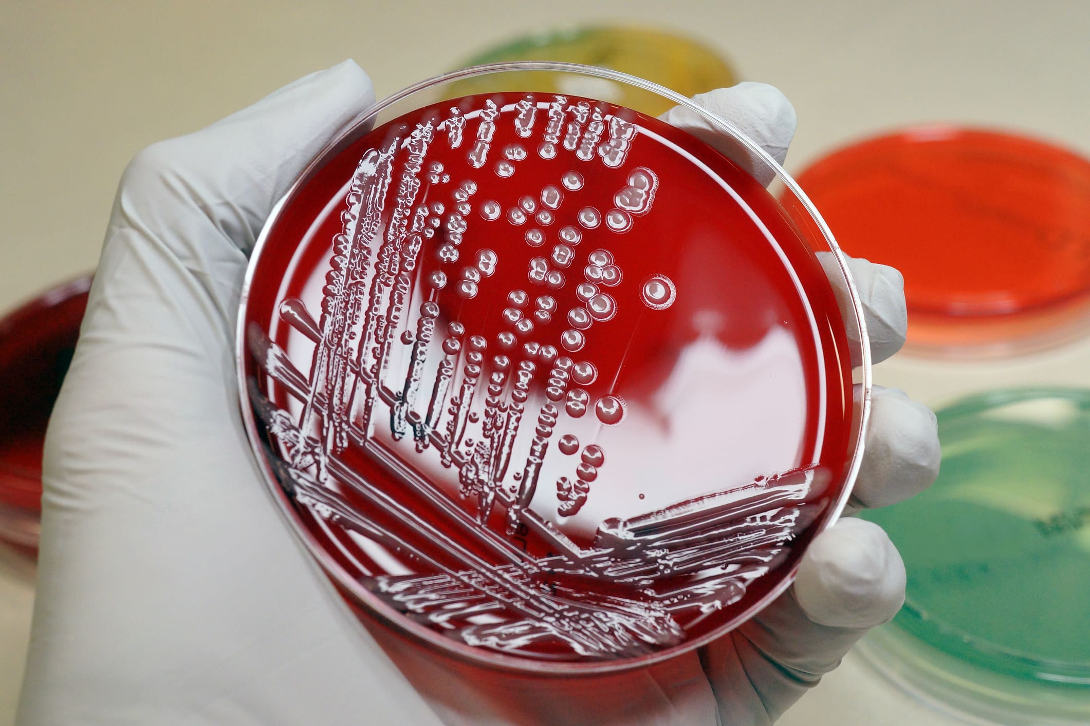 Antibiotic-resistant infections are a ‘major global health threat’ that’s killin..
