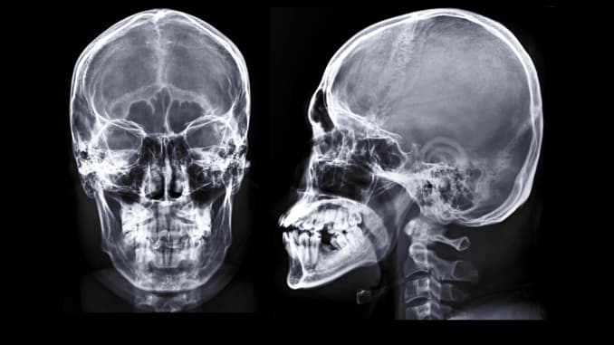 GP: Human Skull X-ray images AP and Lateral View isolated on Black Background