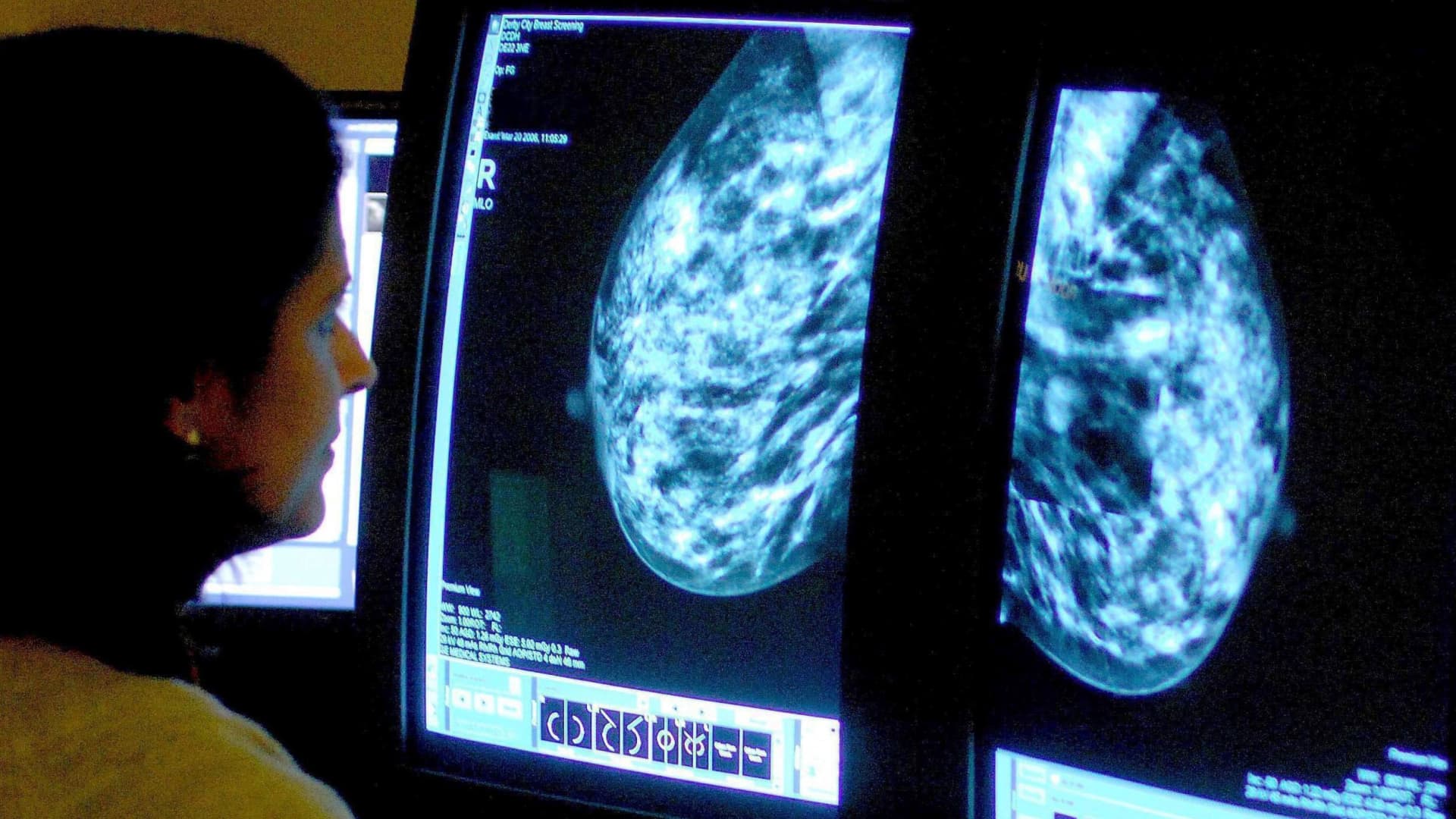 Wetenschappers hebben nieuw licht geworpen op hoe borstkanker in een vroeg stadium zich naar andere organen verspreidt
