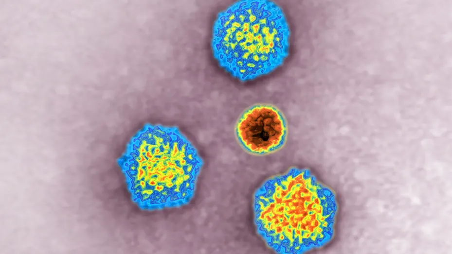 Adenovirus (virus altamente contagioso).  Imagen hecha a partir de una vista de microscopía electrónica de transmisión.