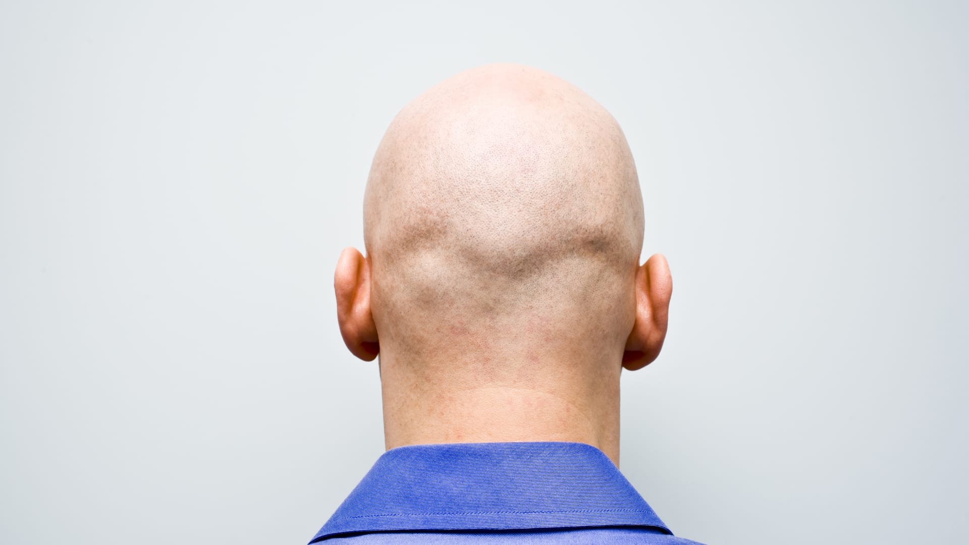 Three members of the tribunal who decided on the ruling, and alluded to their own experience of hair loss, said that baldness was more prevalent in me