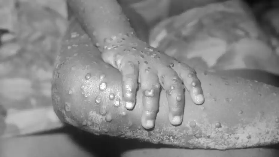 In this 1971 Center For Disease Control handout photo, monkeypox-like lesions are shown on the arm and leg of a female child in Bondua, Liberia.