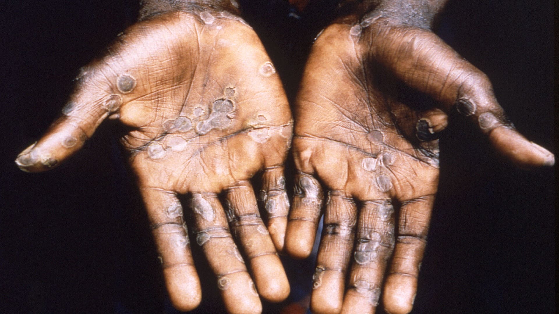 Dr. Scott Gottlieb says emerging monkeypox circumstances counsel it is unfold ‘lovely broad’