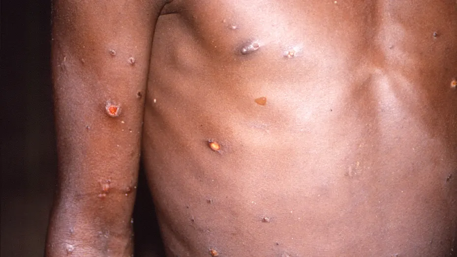 An image created during an investigation into an outbreak of monkeypox, which took place in the Democratic Republic of the Congo, 1996 to 1997, shows the arms and torso of a patient with skin lesions due to monkeypox, in this undated image obtained by Reuters on May 18, 2022. 