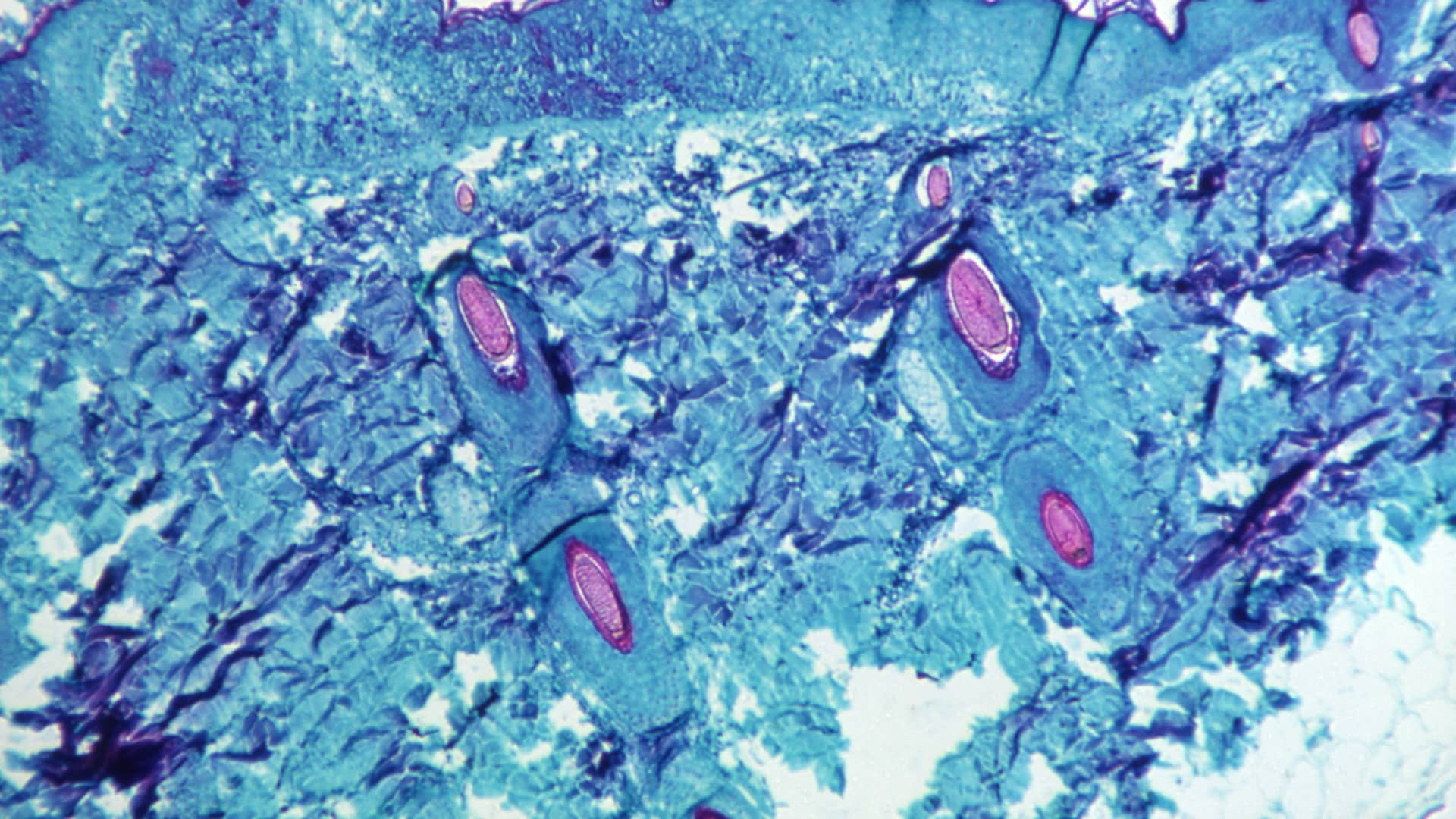 A section of skin tissue, harvested from a lesion on the skin of a monkey, that had been infected with monkeypox virus, is seen at 50X magnification on day four of rash development in 1968. 