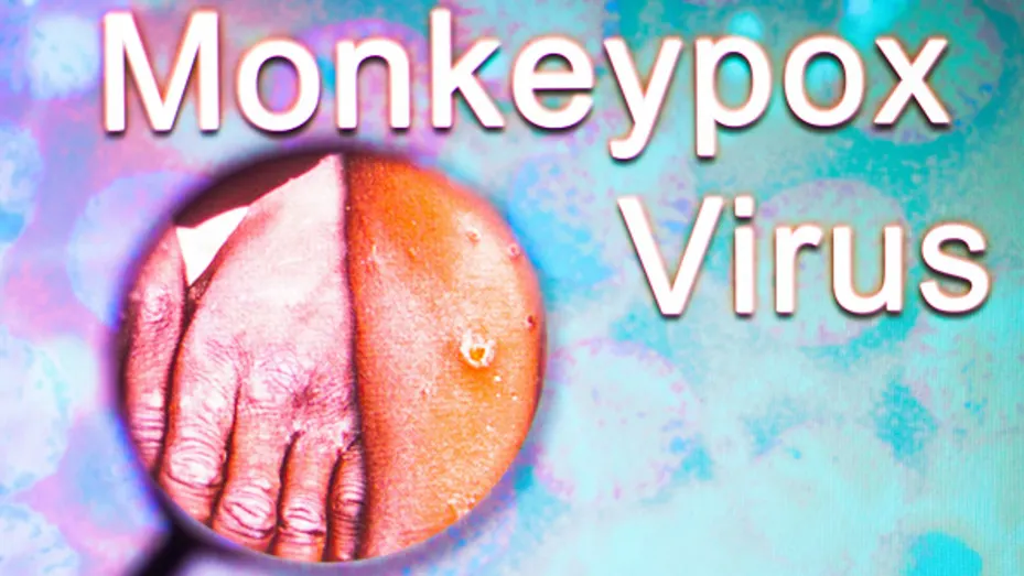 In this photo illustration, a photo of a hand infected with the Monkeypox virus is seen through a magnifying glass. Monkeypox is a viral disease that occurs mainly in central and western Africa.
