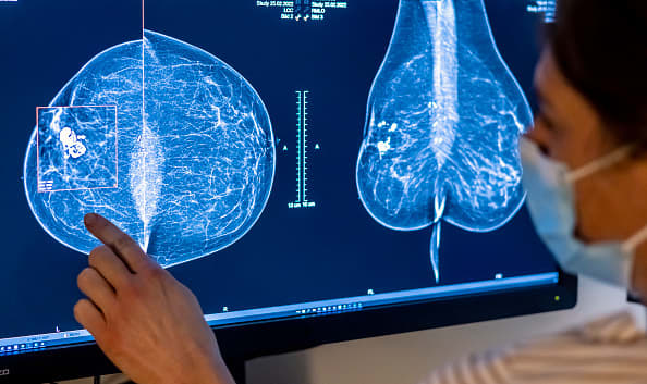 Amerykański panel stwierdził, że badania przesiewowe w kierunku raka piersi powinny rozpocząć się w wieku 40 lat