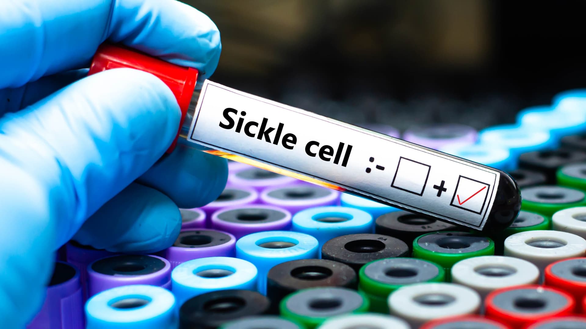 New sickle cell gene therapies are a breakthrough, but solving how to pay their high prices is a struggle