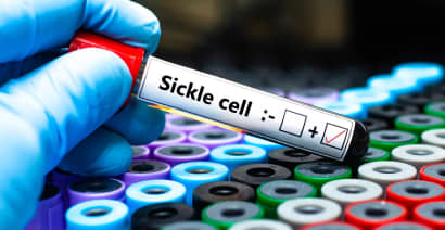 New sickle cell gene therapies are a breakthrough, but paying is a struggle